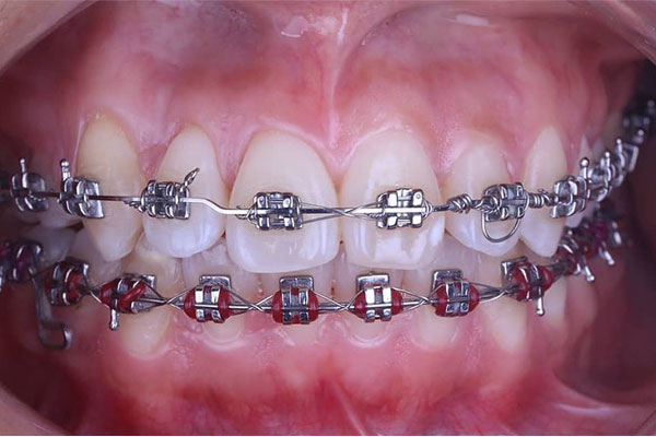 Brackets Dentales at Elite Dental Touch in Miramar, FL