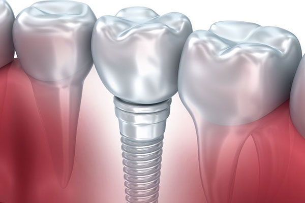Dental Implants at Elite Dental Touch in Miramar, FL