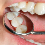 Tooth Bonding / Fillings
