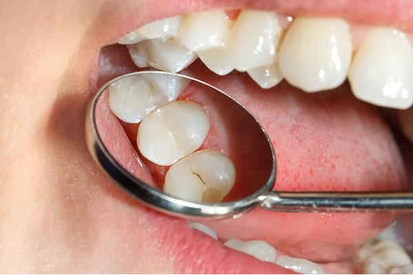 Resina Dental / Empastes at Elite Dental Touch in Miramar, FL