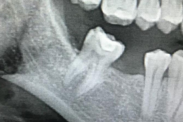 Wisdom Teeth Removal at Elite Dental Touch in Miramar, FL